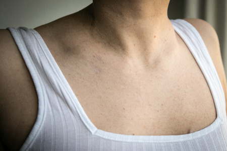 Women with skin pigmentation and lot of birthmarks.