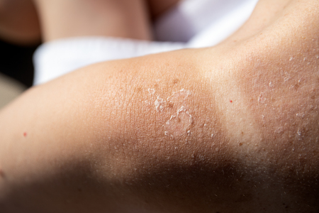 Peeling skin at back and shoulder from sunburn effect. Holidays and relaxation, abstract summer...