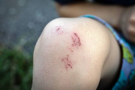 Scratched skin on the kid knee, injury after falling.の写真素材