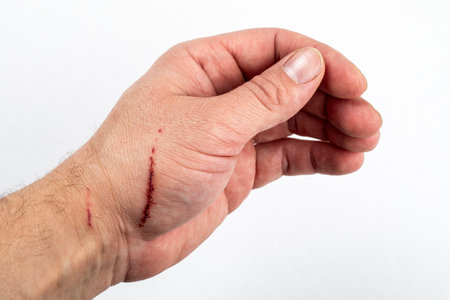 Cat scratched a mans hand. injury and traumaの写真素材
