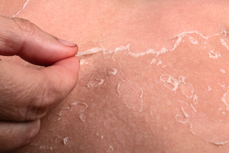 Close-Up of Peeling Skin After Sunburn Showing Dryness, Damage, and Healing Processの写真素材