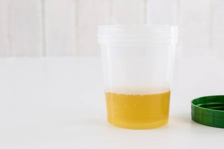Medical urine test, close upの写真素材
