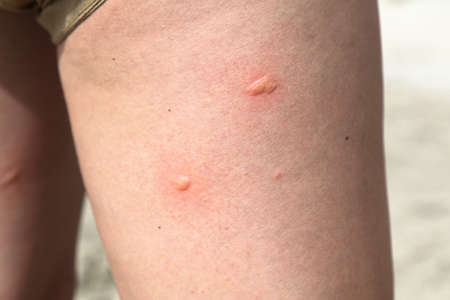 Mosquito bite irritated skin on woman's leg (thigh).の写真素材