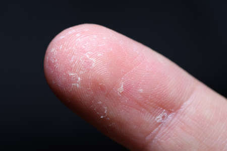 Macro shot of an index finger with eczema