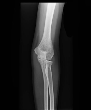 X-ray view of elbowの写真素材