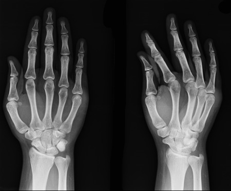 X-ray hand imagesの写真素材