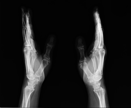 X-ray hand imagesの写真素材