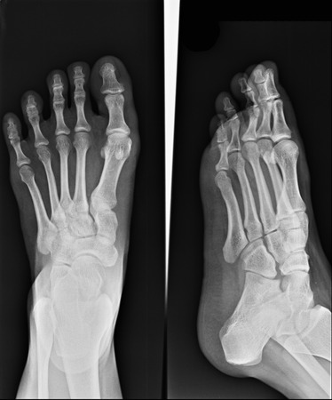 x-ray of footの写真素材