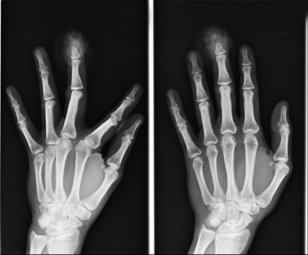 X-ray hand imagesの写真素材