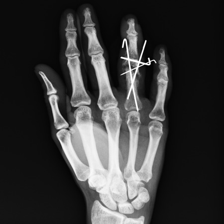 X-ray hand imagesの写真素材