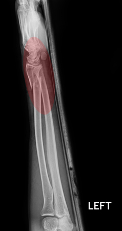 fracture shaft of radius  ulnar bone, x-ray filmの写真素材