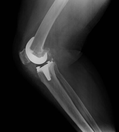knee with total replacement x-ray image on black backgroundの写真素材