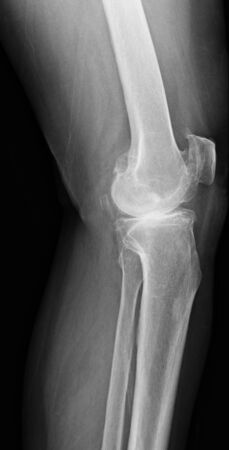 knee with total replacement x-ray image on black backgroundの写真素材