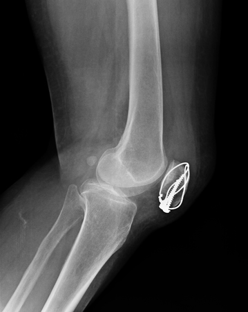 knee with total replacement x-ray image on black backgroundの写真素材