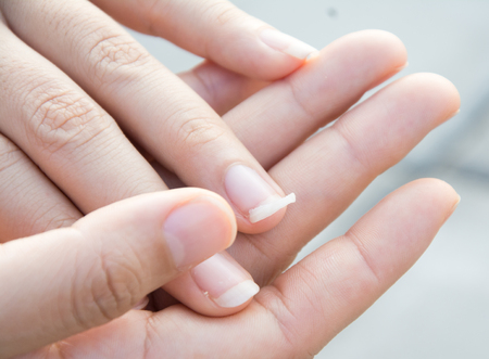 Image of a broken nail handの写真素材