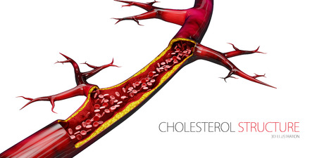 Blocked blood vessel - artery with cholesterol buildup realistic 3d illustration isolated white.の写真素材