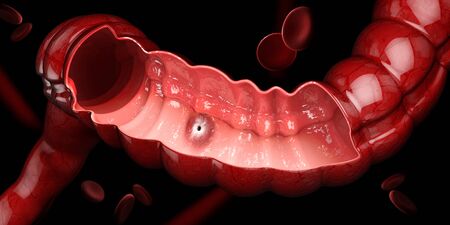 Peptic ulcer, 3d illustration of human stomach anatomy.の写真素材