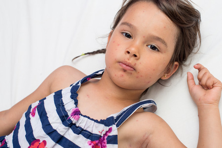 Little girl with varicella, chicken pox, small pox.