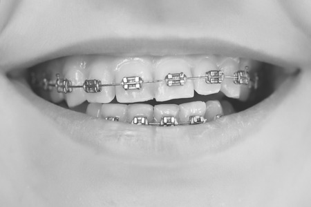 Closeuo of open mouth with clean teeth in brackets of widely smiling young person black and white,...