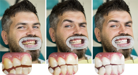 Man isolated on white teeth: before and after concept. Stomatology concept - close up of female dentist with male patient teeth. White teeth or yellow.の写真素材