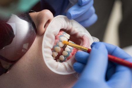 Close-up portrait of a female patient at dentist in the clinic. Hollywood smile veneers. Dentist in...