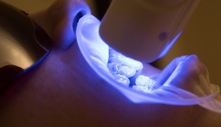Close-up portrait of a female patient at dentist in the clinic. Set of implants with various shades of tone. Matching the shades of the implants or the process of teeth whitening.の写真素材