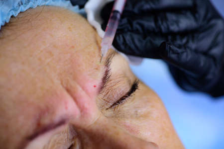 Closeup woman injection. Age changes. Cosmetology Treatment. Procedure augmentation. Syringe female face, hyaluronic injection.の写真素材