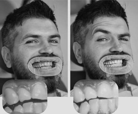 Whitening after and before. Man in dental chair. Dentist preparing for dental whitening. Health medicine people dentistry doctor curing. Result of teeth whitening.の写真素材