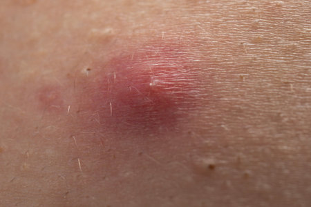 Acne skin pimple. Skin problem with pimple bumps. Irritated pimple texture. Close up pimple issue.
