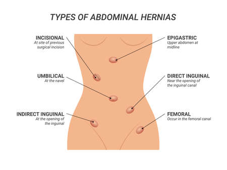Types of abdominal hernias illustration on isolated backgroundのイラスト素材