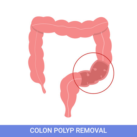 Colonoscopy intestine, polypectomy procedure, removal polyp in colon. colon surgeryのイラスト素材