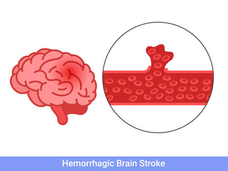 Hemorrhagic brain stroke concept. Apoplexy, cerebral hemorrhage, headache problemのイラスト素材