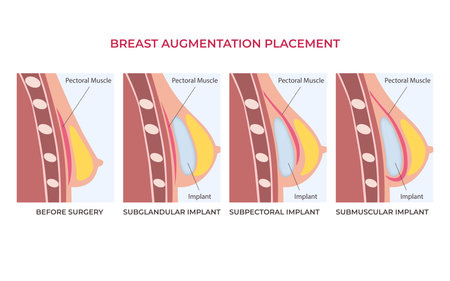 Breast implant types in female silhouette. Subglandular, subpectoral, submuscular placementのイラスト素材