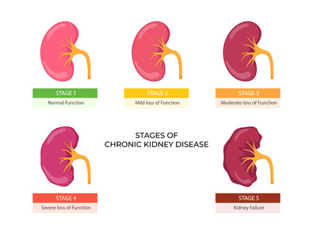 Stages of chronic kidney disease. Problem in urinary system and normal kidneyのイラスト素材