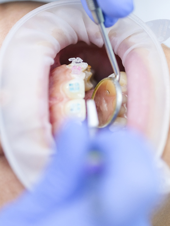 Mouth of dentist's patient close upの写真素材