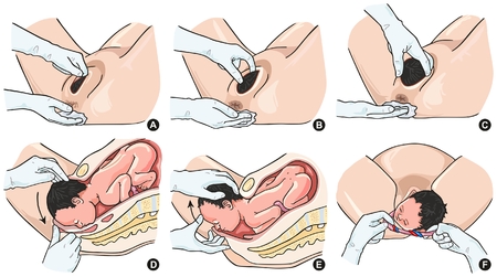 Normal Delivery Steps infographic diagram including all stages of labor and baby birth for medical science educationのイラスト素材