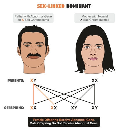 Sex-linked Dominant Hereditary Trait infographic diagram showing father with abnormal gene on X sex chromosome while mother has normal ones for genetics and medical science educationのイラスト素材