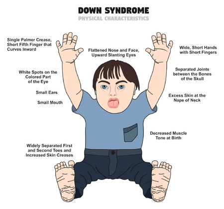 Down Syndrome Physical Characteristics infographic diagram showing affected kid born with this disability for medical science health care and people awarenessのイラスト素材