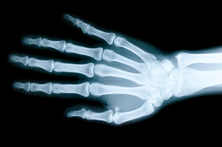 Right hand X-ray images to detect abnormalities of the hand.の写真素材