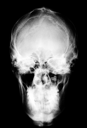 Monochrome X-ray image of human front skull in order to detect abnormalities or damage that occurs to the patientskull.の写真素材