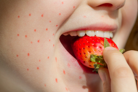 Allergy food strawberry and abstract allergic reaction on the girl's faceの写真素材