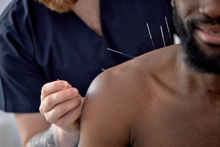acupuncture therapy on back spine shoulders for black client. cropped young man undergoing acupuncture treatment with a line of fine needles inserted into body skin in clinic hospital, close-upの写真素材