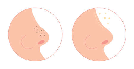 Blackheads on nose cleaning flat illustration. Washing face with clogged pores. Blackheads removal, skin cleaning, skincare. Can be used for topics like cosmetology, cosmetics. Shrinking and minimaiziのイラスト素材