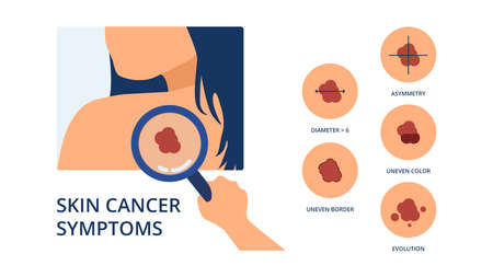 Skin cancer symptoms like big diameter, asymmetry, uneven color, uneven border and evolution next to hand of doctor detecting melanoma spot on skin of womanのイラスト素材