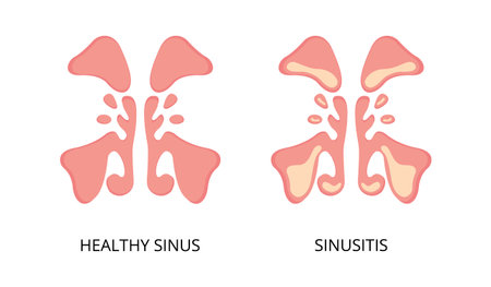 Healthy sinus and sinusitis flat image. Infection, inflammation, nasal diseases. Can be used for topics like health, diagnosis, anatomyのイラスト素材