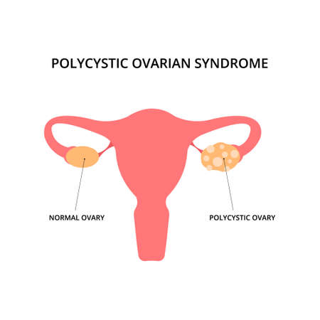 Polycystic ovarian syndrome. Uterus, infertility, gynecology. For topics like pcos, disease, pelvic floorのイラスト素材