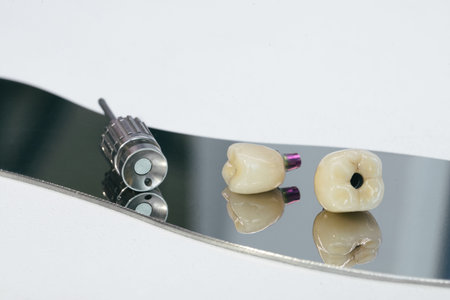 Zirconium crown and zirconium hybrid abutment. Monolithic screw retained zirconium crown on the...