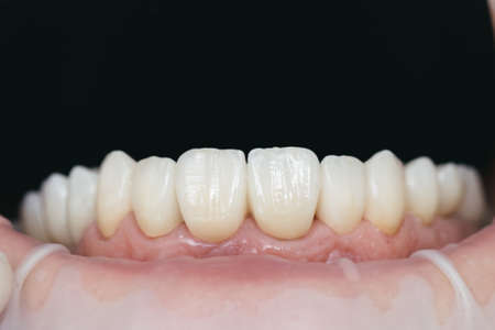 Dental health care. Ceramic zirconium in final version. Staining and glazing. Precision design and high quality materialsの写真素材