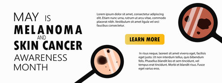 Melanoma and skin cancer awareness month landing page template. Banner template with moles, birthmarks under magnifying glass and copy space for text. Vector illustrationのイラスト素材