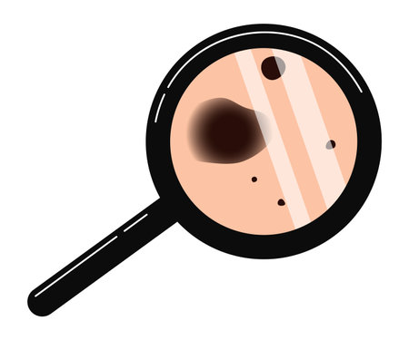 Melanoma diagnosis, skin cancer prevention icon. Checking moles, birthmarks under magnifier. Vector illustration isolated on white backgroundのイラスト素材